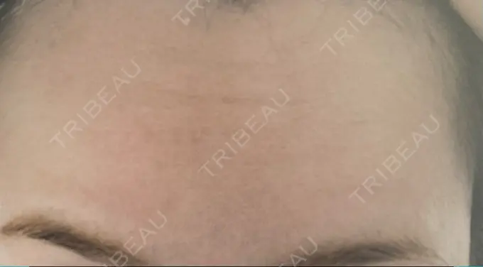 ボトックス（額） 湘南美容クリニック 大阪あべの院 DAY 1 メイン用