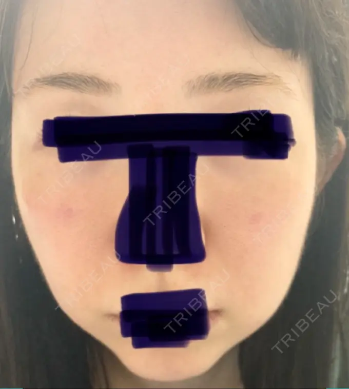 ハイフ（顔） 湘南美容クリニック 大阪あべの院 DAY 1 メイン用