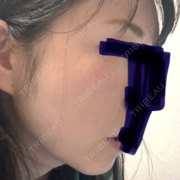 ハイフ（顔） 湘南美容クリニック 大阪あべの院 DAY 1 メイン用