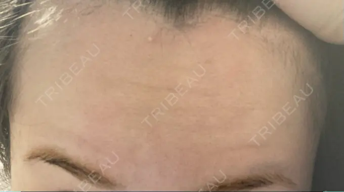 ボトックス（額） 湘南美容クリニック 大阪あべの院 DAY 3 メイン用