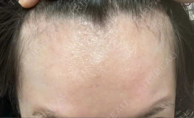 ボトックス（額） 湘南美容クリニック 大阪あべの院 AFTER メイン用