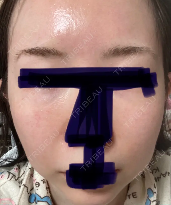 ハイフ（顔） 湘南美容クリニック 大阪あべの院 AFTER メイン用