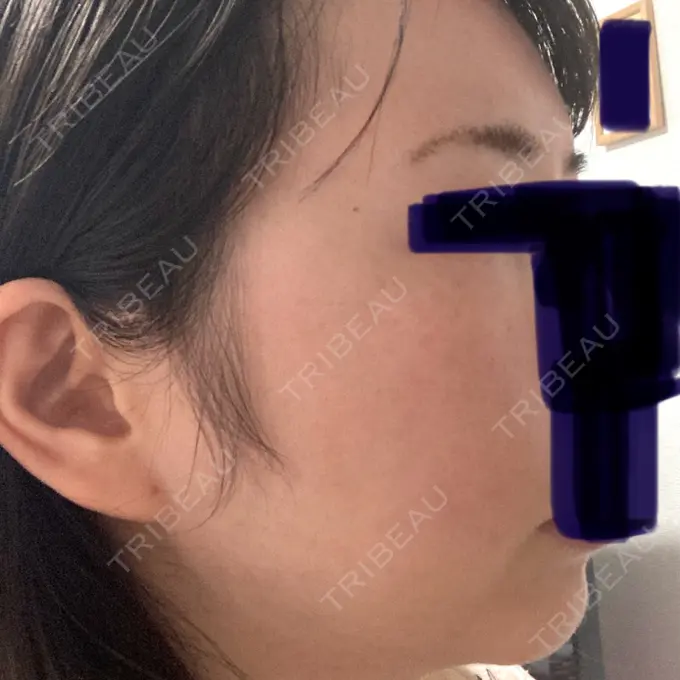 ハイフ（顔） 湘南美容クリニック 大阪あべの院 DAY 6 メイン用