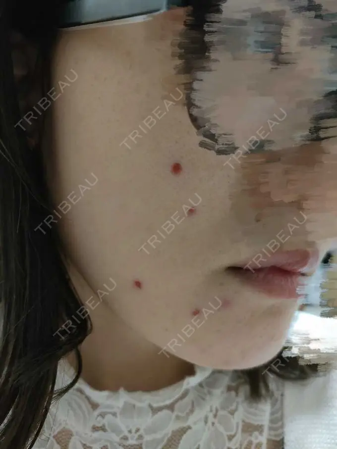 シミ取りレーザー 小田原マタニティクリニック DAY 3 メイン用