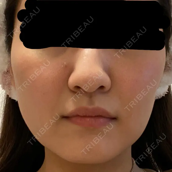 糸リフト / バッカルファット除去 / 脂肪吸引（顔） 東京ミッドクリニック DAY 41 メイン用