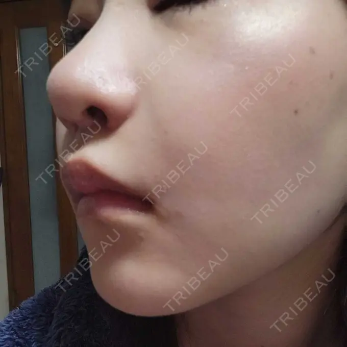 小鼻縮小（切開） くさのたろうクリニック DAY 9 メイン用