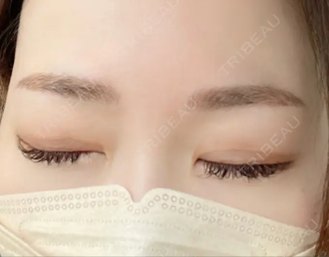 アートメイク（眉） 表参道ウィズ・クリニック DAY 1 メイン用