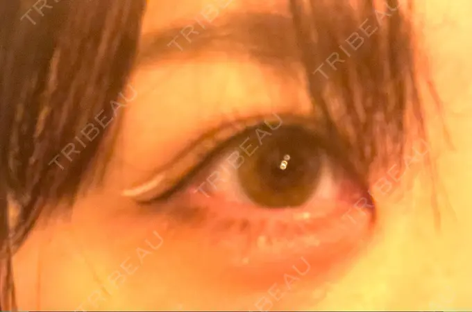 ヒアルロン酸注入（涙袋） / ボトックス（眉間） TCB東京中央美容外科 心斎橋院 DAY 134 メイン用