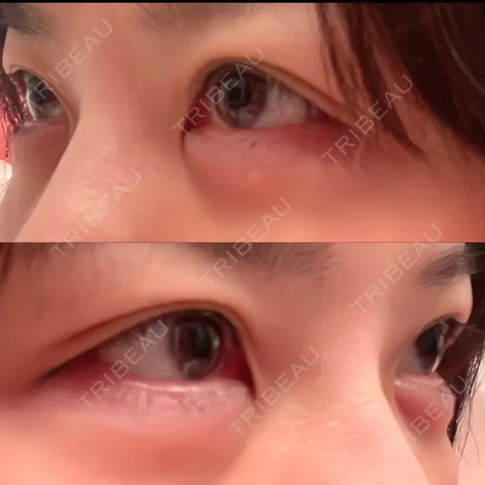 ヒアルロン酸注入（涙袋） / ボトックス（眉間） TCB東京中央美容外科 心斎橋院 DAY 134 メイン用