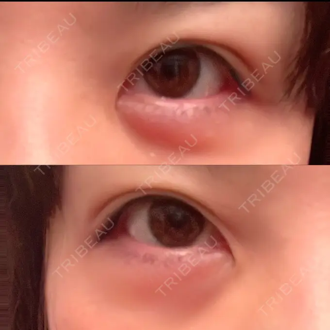 ヒアルロン酸注入（涙袋） / ボトックス（眉間） TCB東京中央美容外科 心斎橋院 DAY 134 メイン用