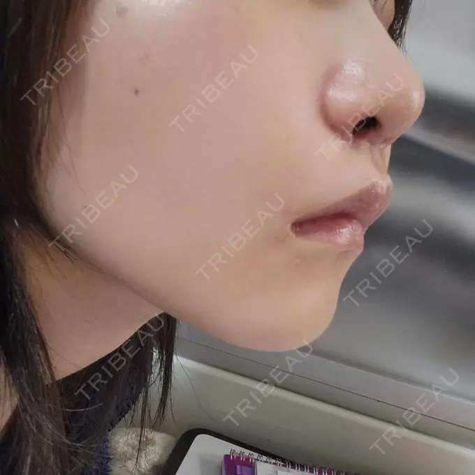 小鼻縮小（切開） くさのたろうクリニック DAY 10 メイン用