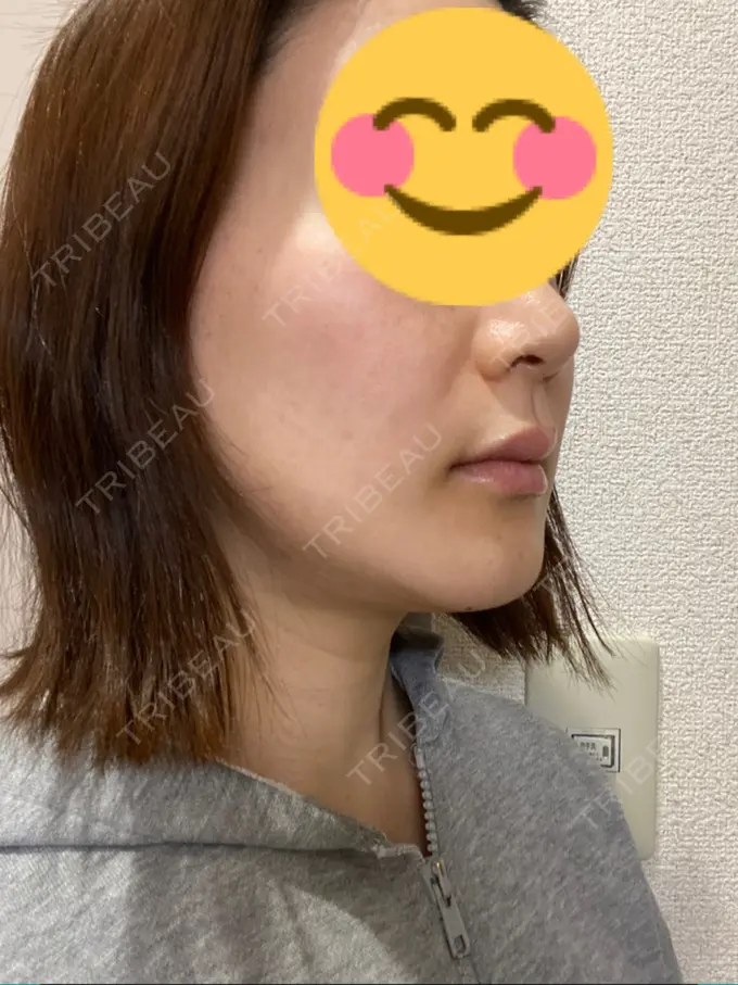 骨切り（あご） / 骨削り（エラ） / セットバック / その他（輪郭） アーククリニック DAY 12 メイン用