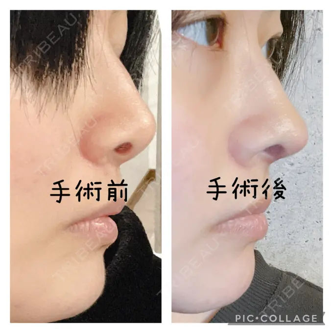 鼻中隔延長（切開） みずほクリニック DAY 29 メイン用