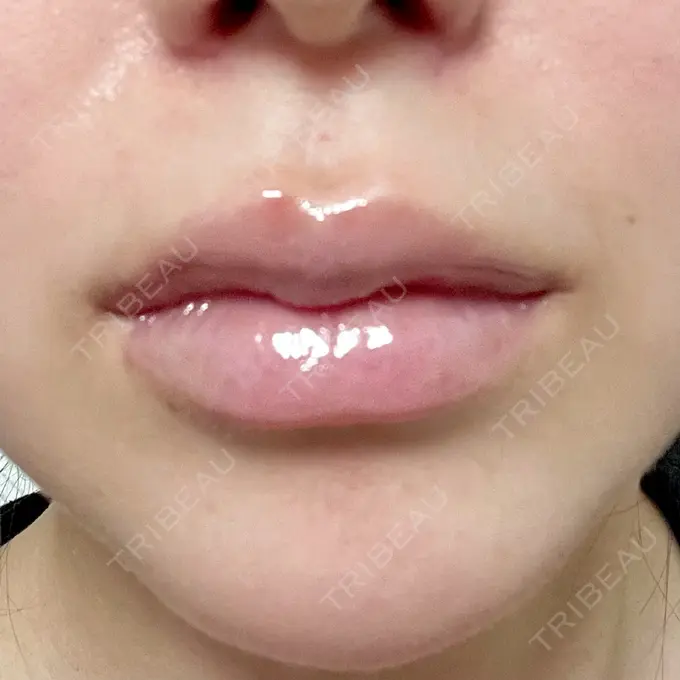 ヒアルロン酸注入（唇） / ボトックス（口角） ルラ美容クリニック 大阪本院 DAY 6 メイン用