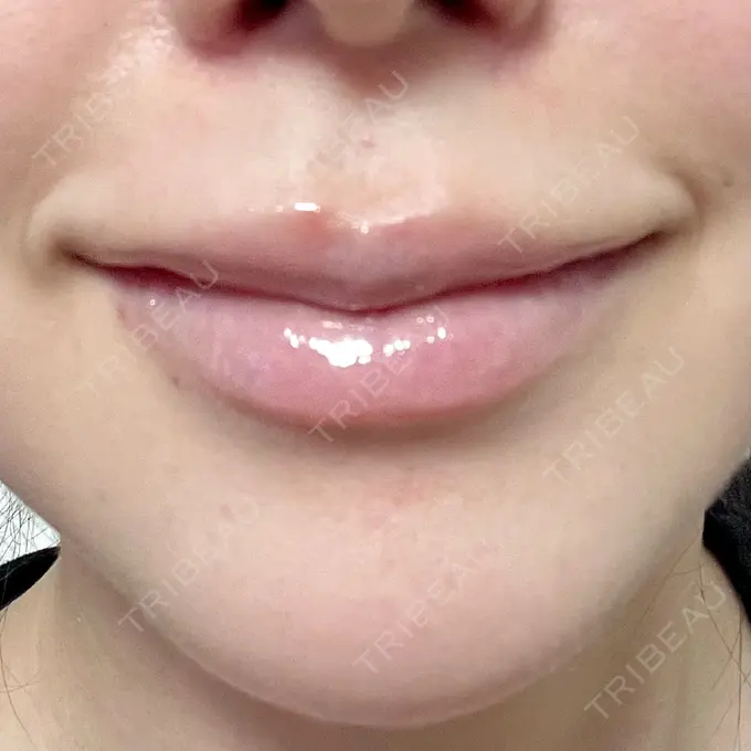 ヒアルロン酸注入（唇） / ボトックス（口角） ルラ美容クリニック 大阪本院 DAY 6 メイン用