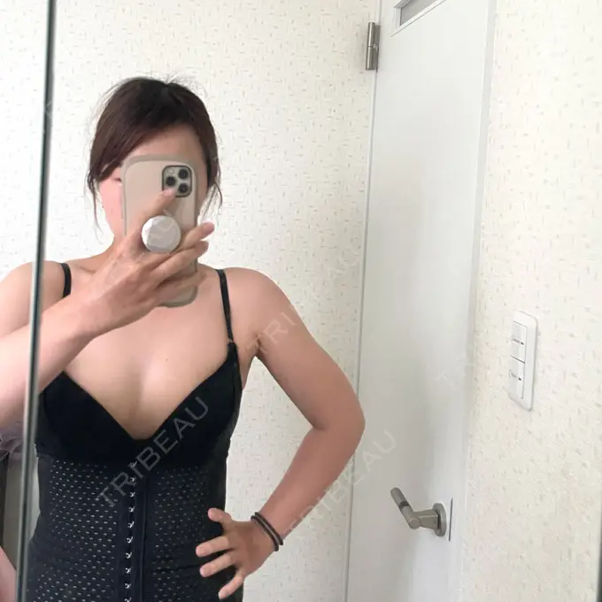 脂肪吸引（二の腕） / 脂肪吸引（肩） / ボトックス（肩） / ボトックス（首） Mods Clinic（モッズクリニック） 東京院 AFTER メイン用