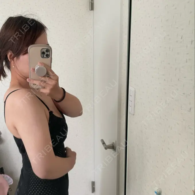 脂肪吸引（二の腕） / 脂肪吸引（肩） / ボトックス（肩） / ボトックス（首） Mods Clinic（モッズクリニック） 東京院 DAY 34 メイン用