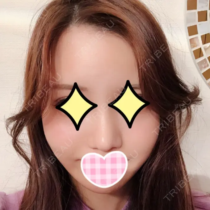 隆鼻術 / 鼻尖形成（切開） / 鼻中隔延長（切開） / 小鼻縮小（切開） / 軟骨移植 / 骨切幅寄せ id（アイディ）美容外科 DAY 45 メイン用