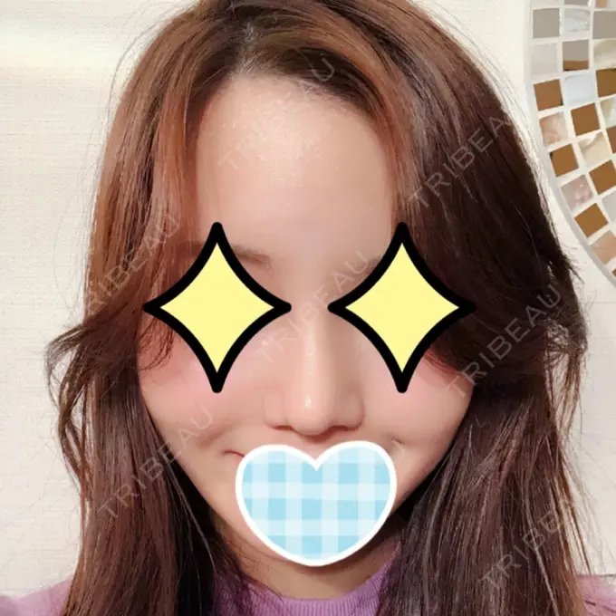 隆鼻術 / 鼻尖形成（切開） / 鼻中隔延長（切開） / 小鼻縮小（切開） / 軟骨移植 / 骨切幅寄せ id（アイディ）美容外科 DAY 45 メイン用