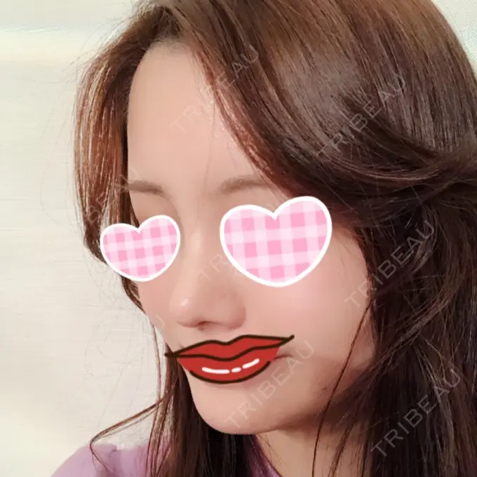 隆鼻術 / 鼻尖形成（切開） / 鼻中隔延長（切開） / 小鼻縮小（切開） / 軟骨移植 / 骨切幅寄せ id（アイディ）美容外科 DAY 45 メイン用