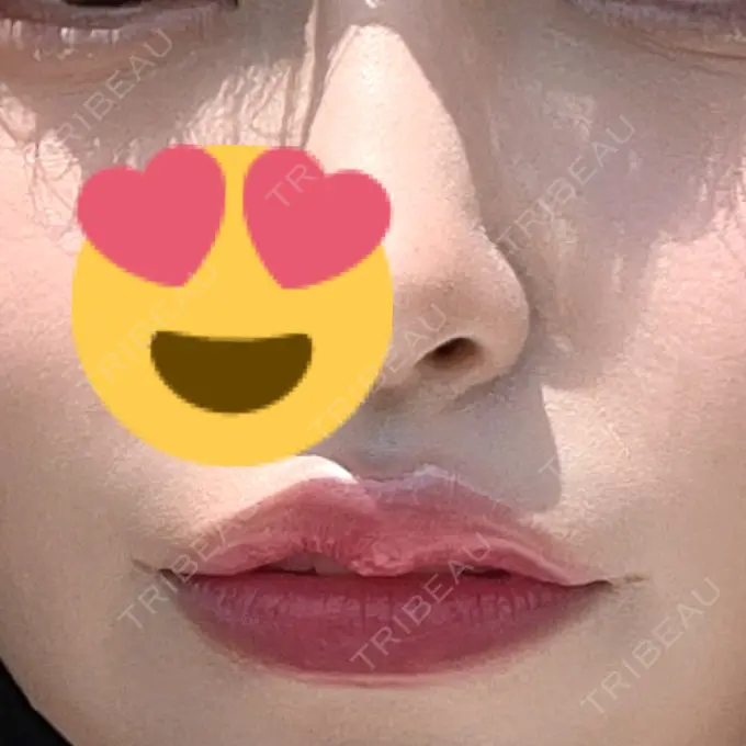 ボトックス（人中） AILE Clinic AFTER メイン用