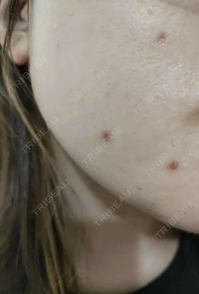 シミ取りレーザー 小田原マタニティクリニック DAY 7 メイン用