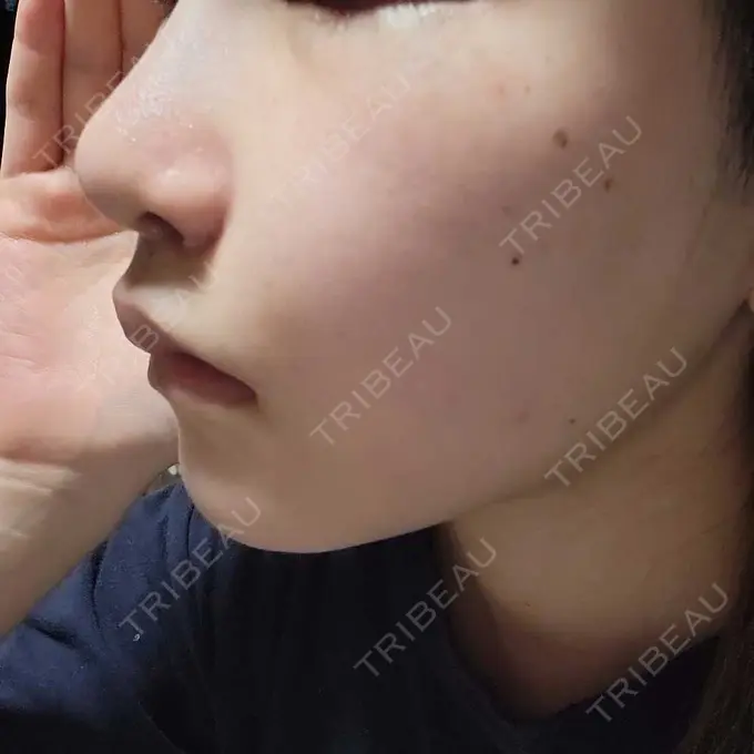 小鼻縮小（切開） くさのたろうクリニック AFTER メイン用