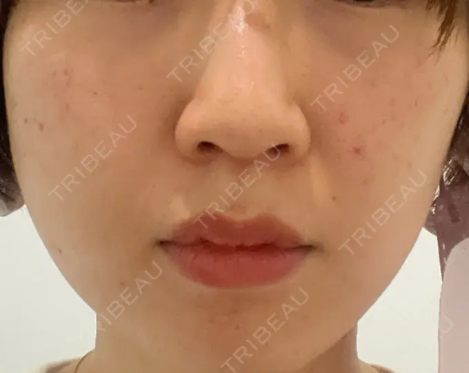 ハイフ（顔） STARS CLINIC DAY 30 メイン用