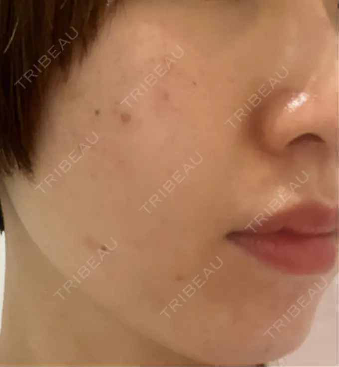 ハイフ（顔） STARS CLINIC DAY 30 メイン用