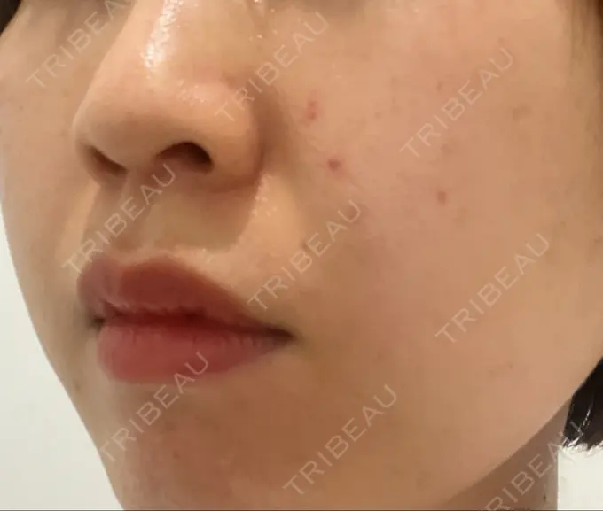 ハイフ（顔） STARS CLINIC DAY 30 メイン用