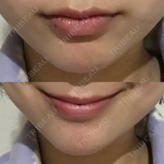 あごプロテーゼ 北尾クリニック DAY 32 メイン用