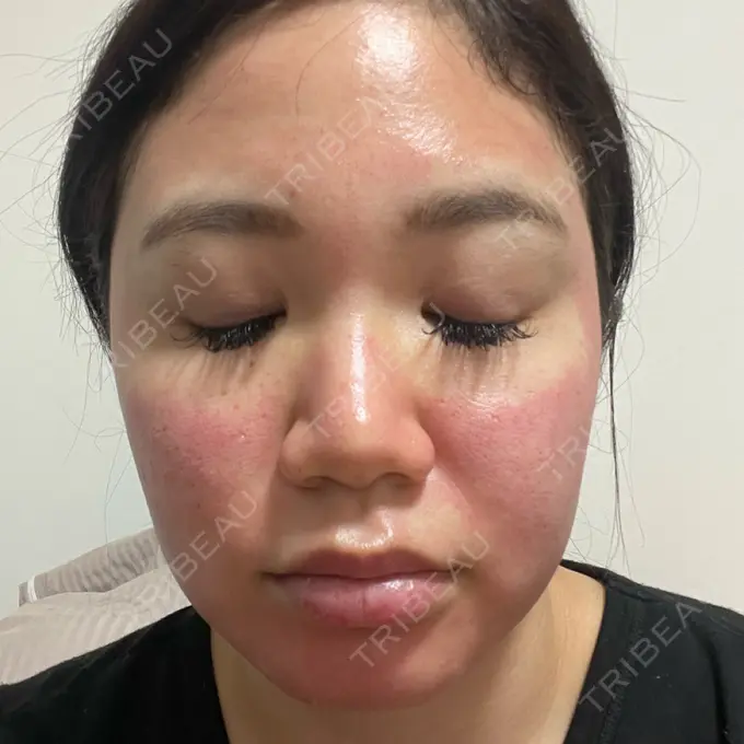 ヴェルヴェットスキン フローラクリニック DAY 1 メイン用