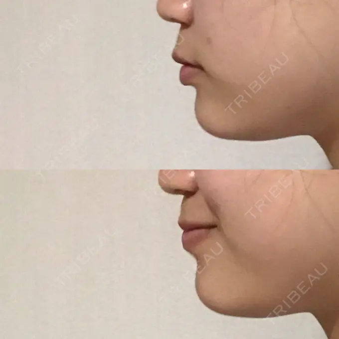 あごプロテーゼ 北尾クリニック DAY 32 メイン用