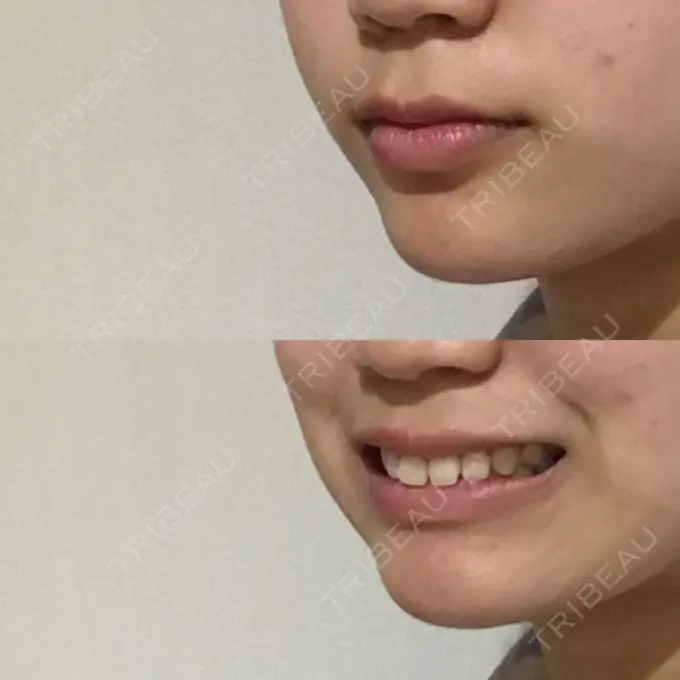 あごプロテーゼ 北尾クリニック DAY 32 メイン用