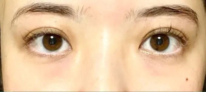 眉下切開 Taide Suenaga Clinic（タイデスエナガクリニック） AFTER メイン用