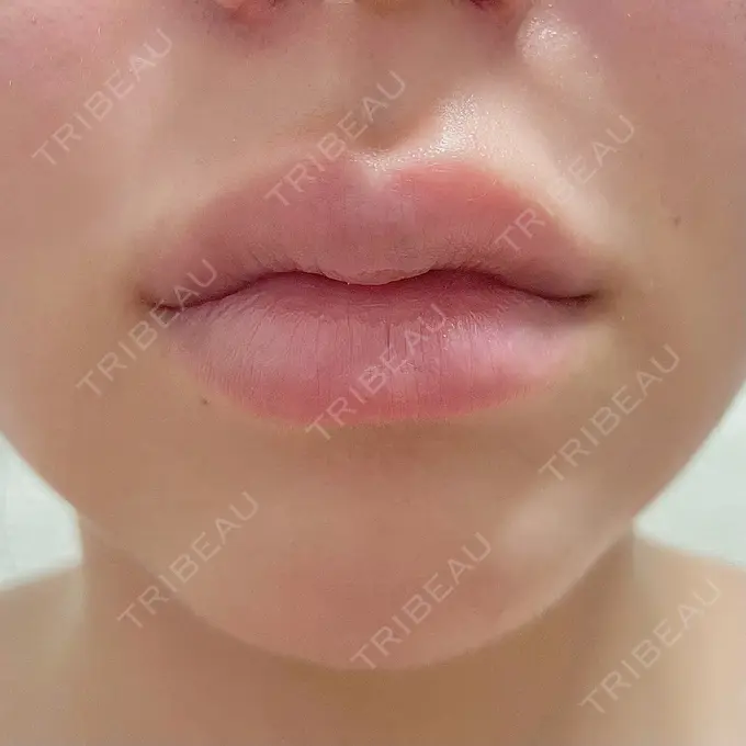 ヒアルロン酸注入（唇） / ボトックス（口角） ルラ美容クリニック 大阪本院 DAY 9 メイン用