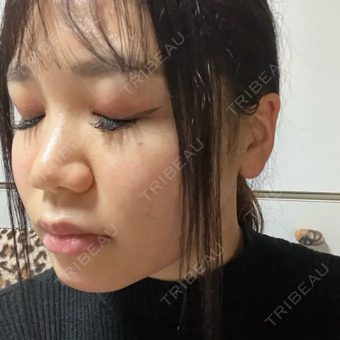 ヴェルヴェットスキン フローラクリニック DAY 2 メイン用