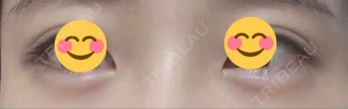 ヒアルロン酸注入（涙袋） フィラークリニック 名古屋栄院 AFTER メイン用