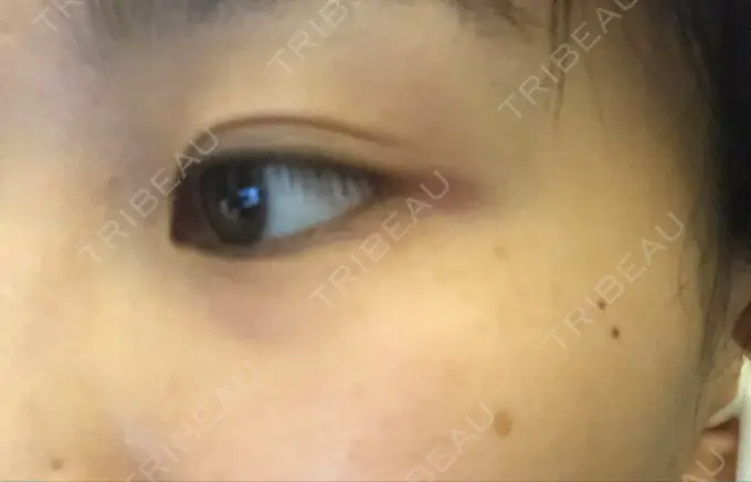 ピコレーザートーニング（美白・肝斑） B-LINE CLINIC 池袋院 DAY 1 メイン用