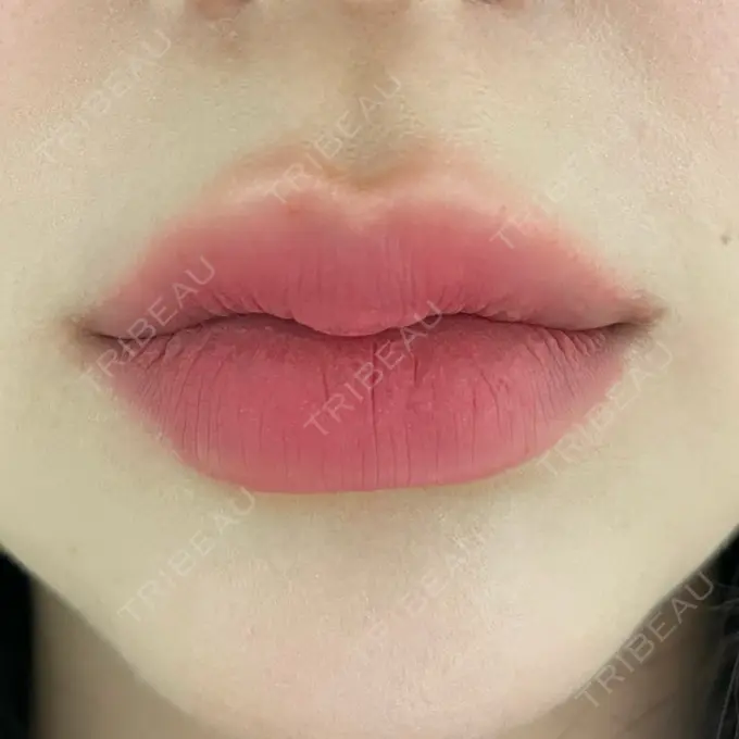 ヒアルロン酸注入（唇） / ボトックス（口角） ルラ美容クリニック 大阪本院 AFTER メイン用