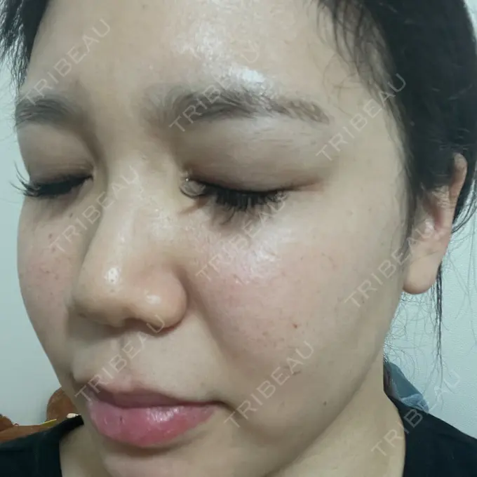 ヴェルヴェットスキン フローラクリニック AFTER メイン用