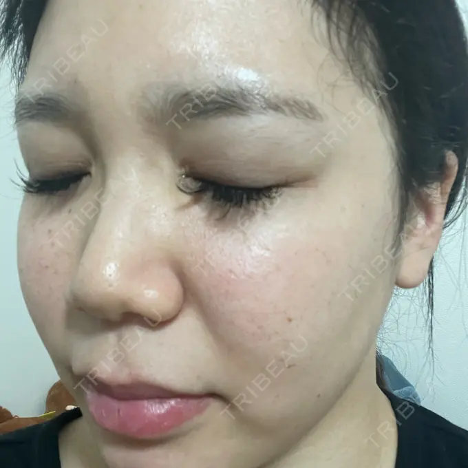 ヴェルヴェットスキン フローラクリニック DAY 3 メイン用