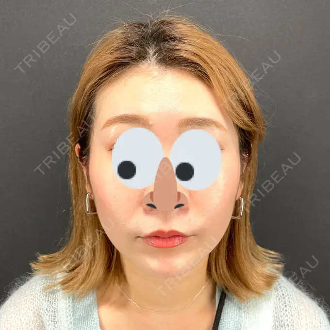 肌ヒアルロン酸注入（たるみ・シワ改善） / ヒアルロン酸注入（あご） / ボトックス（エラ・小顔） X CLINIC 恵比寿院 DAY 0 メイン用