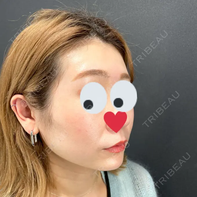 肌ヒアルロン酸注入（たるみ・シワ改善） / ヒアルロン酸注入（あご） / ボトックス（エラ・小顔） X CLINIC 恵比寿院 DAY 0 メイン用