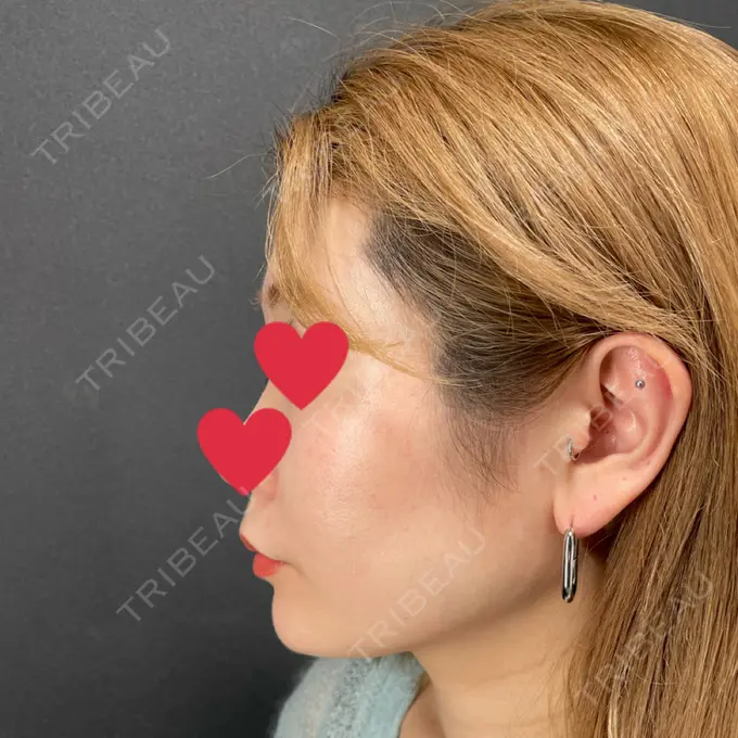 肌ヒアルロン酸注入（たるみ・シワ改善） / ヒアルロン酸注入（あご） / ボトックス（エラ・小顔） X CLINIC 恵比寿院 DAY 0 メイン用