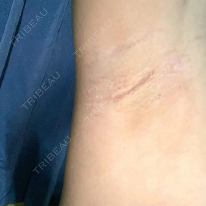 豊胸（シリコンバッグ） ジョウクリニック 那覇院 DAY 24 メイン用