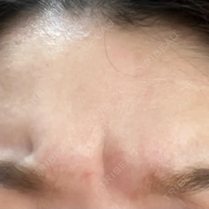 シワ取りボトックス / マイクロボトックス / ボトックス（額） ルラ美容クリニック 新宿院 DAY 0 メイン用