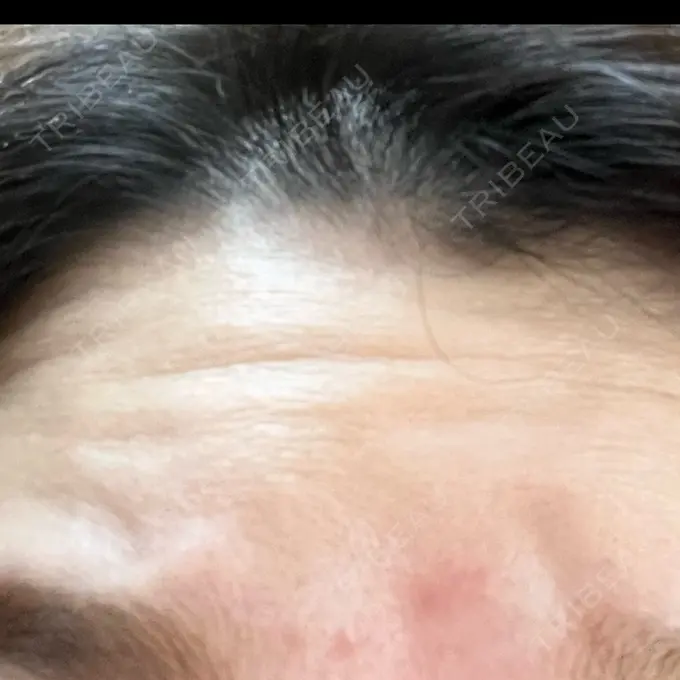 シワ取りボトックス / マイクロボトックス / ボトックス（額） ルラ美容クリニック 新宿院 DAY 0 メイン用