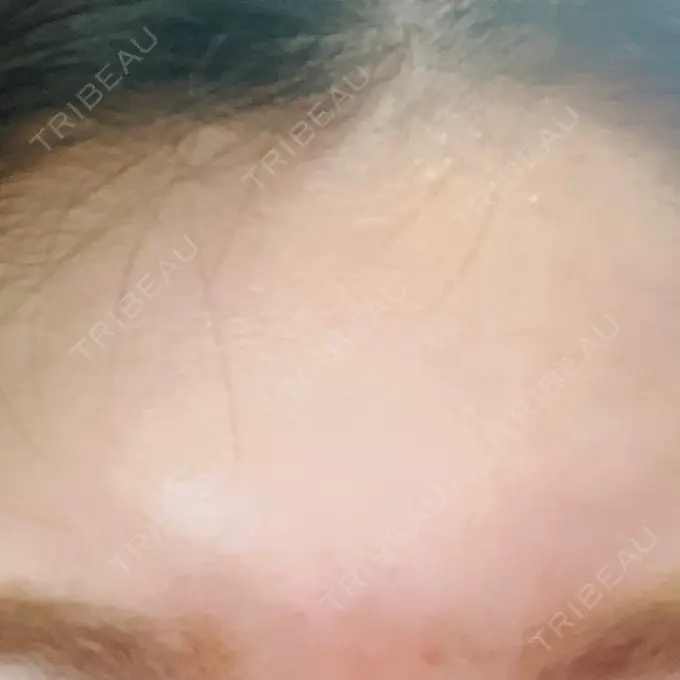 シワ取りボトックス / マイクロボトックス / ボトックス（額） ルラ美容クリニック 新宿院 AFTER メイン用