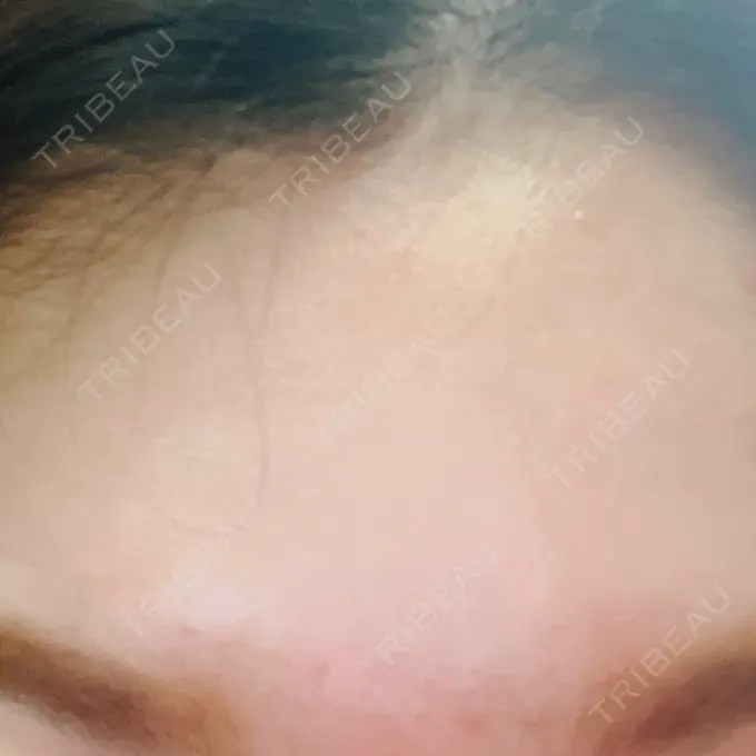 シワ取りボトックス / マイクロボトックス / ボトックス（額） ルラ美容クリニック 新宿院 DAY 4 メイン用